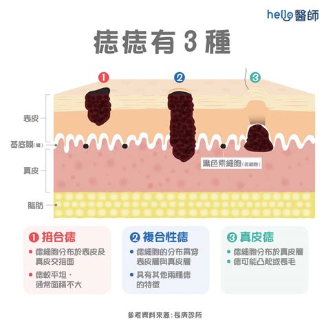 痣長毛代表什麼|痣為什麼會長毛？了解痣與毛髮的關係與原因